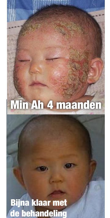 eczeem eczeem